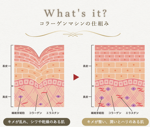 コラーゲンマシンの仕組み